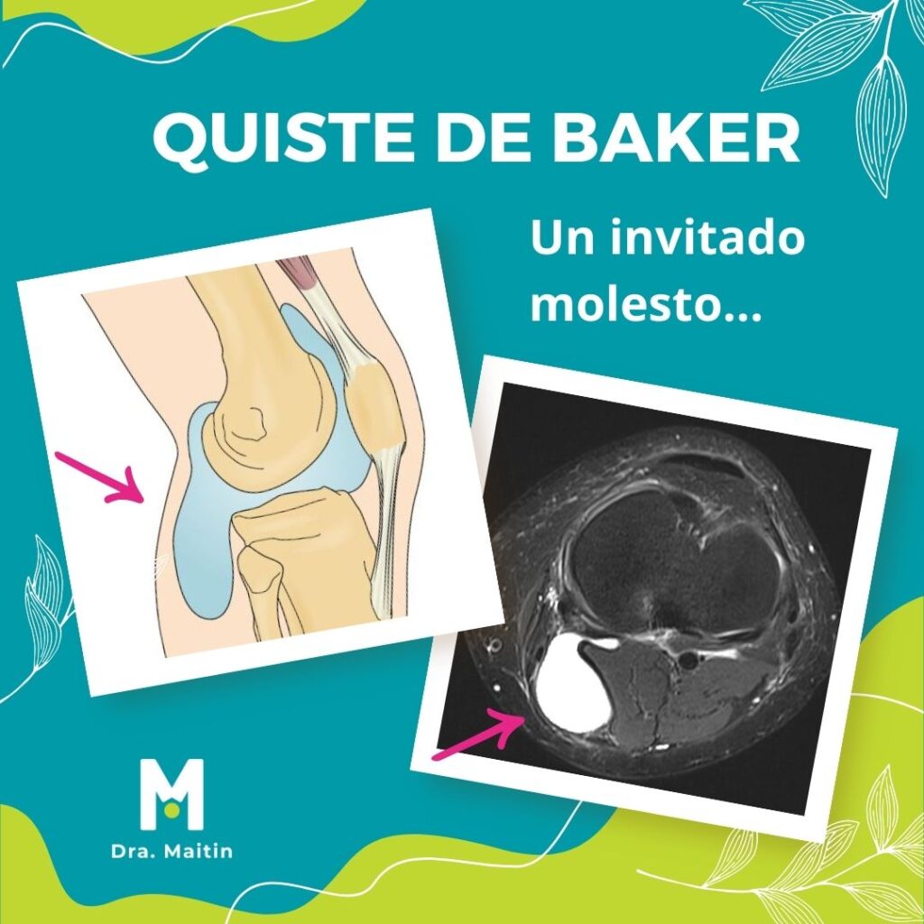 Quiste de Baker Dra Maitin